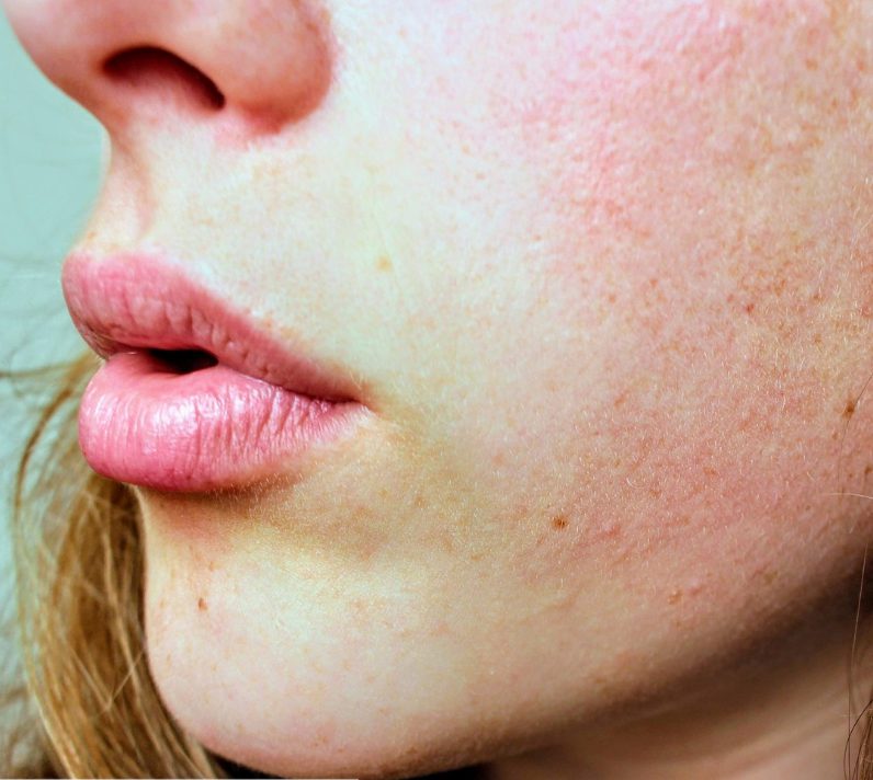 Why Dermatologists Should Use Platelet-Rich Plasma (PRP)